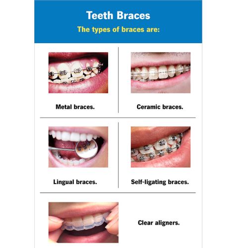 Types of Braces Napoli Orthodontics Stuart Fl